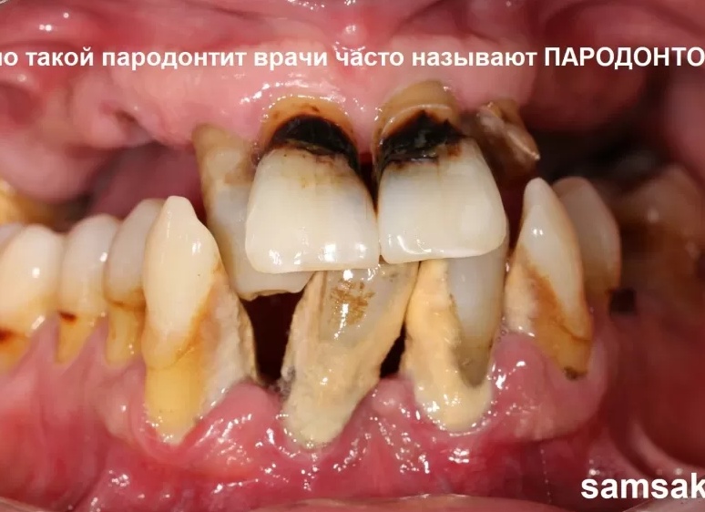 Лечится пародонтит или нет, и если да, то как