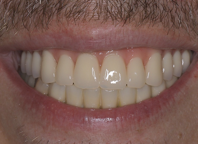 Почему на верхней челюсти имплантаты приживляются куда дольше, чем на нижней