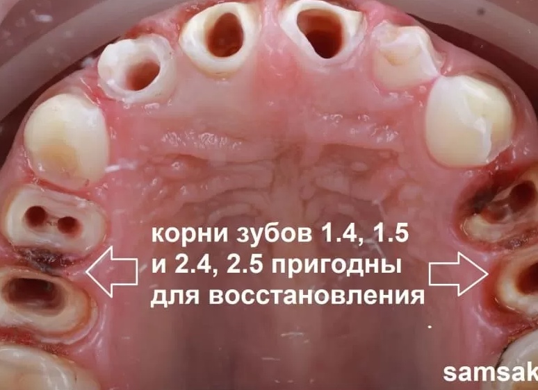 Почему на верхушках депульпированных корней образуются гранулемы и почему живой зуб всегда лучше мертвого
