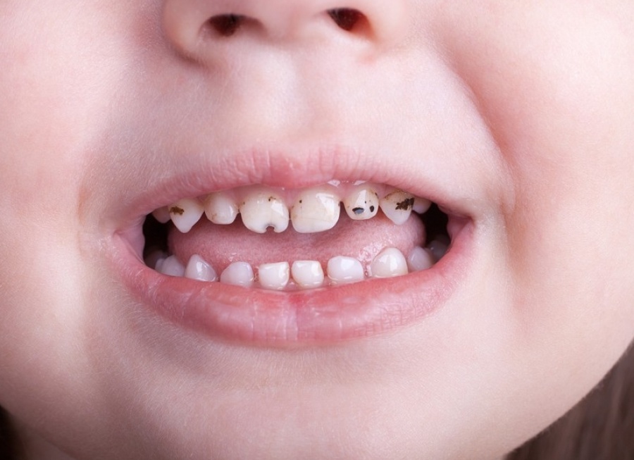 Когда детям зубы лечить, а когда удалять