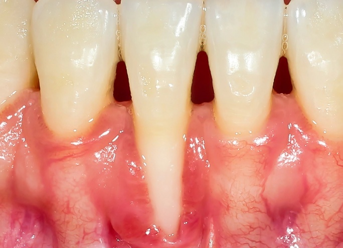 Как быть, если зуб лечили по поводу глубокого кариеса, а он разболелся