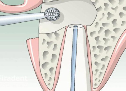 Почему резекция верхушки корня хуже, чем повторное лечение каналов