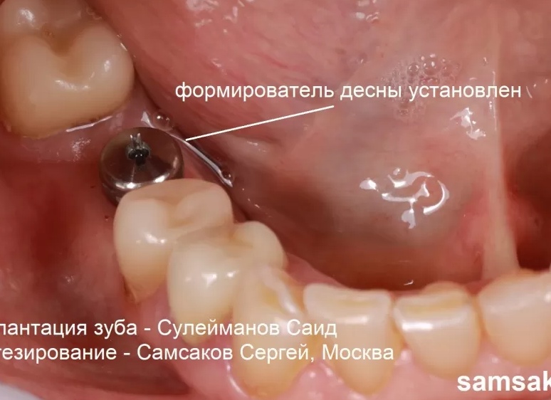 Какова судьба заглушек, формирователей, временных коронок и моделей после лечения