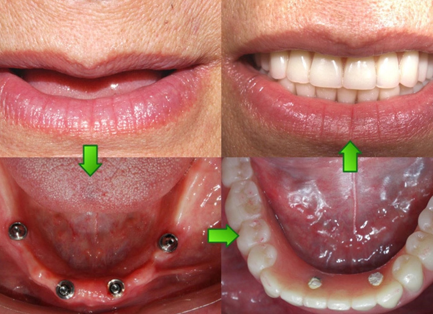 Четыре истории о неприжившихся дважды имплантатах, что редкость, но бывает
